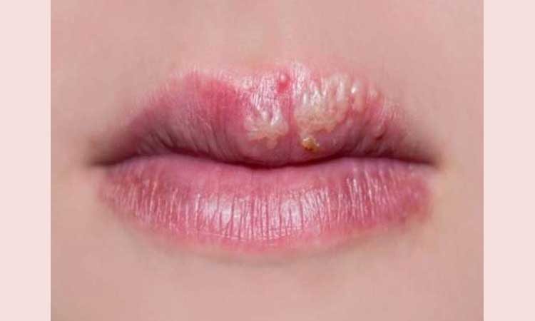 lips cancer lip cancers causes symptoms treatment