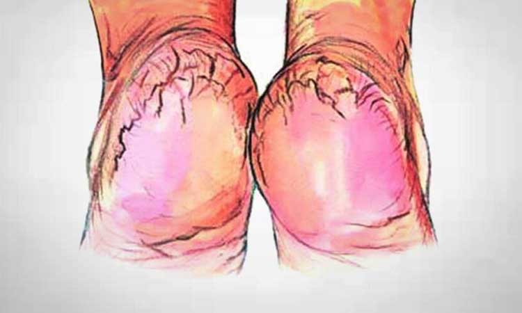 Cracked Heels Remedies | how to get rid of cracked heels in winters home remedies marathi news