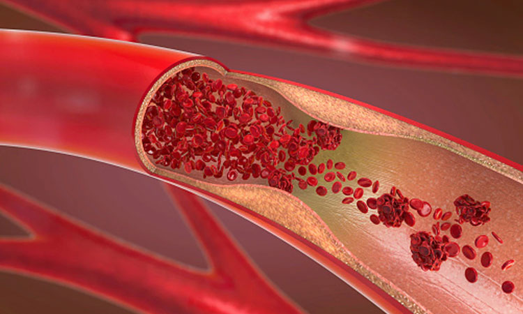 8 signs of a blood clot you should never ignore
