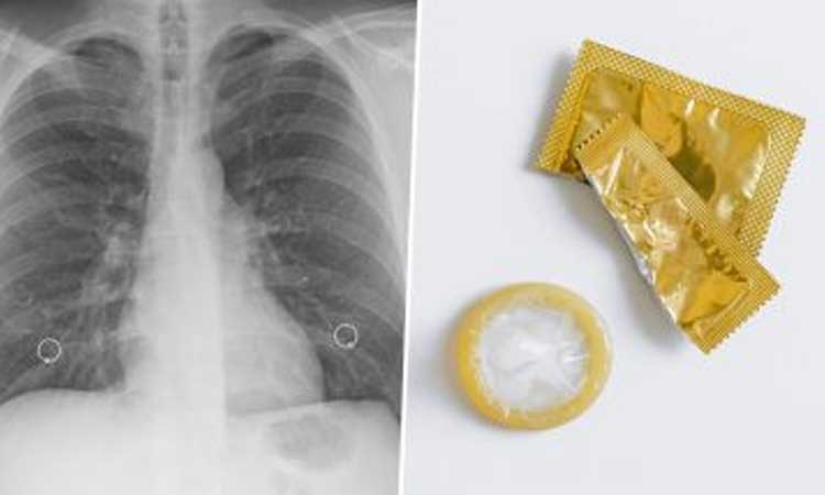 condom stuck in womans lung woman rushed to doctor on fear of tb but she stunned after knowing the truth