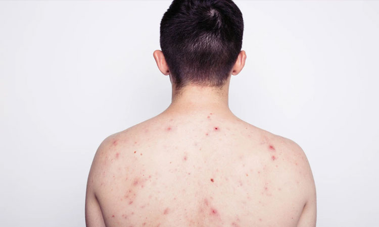 to get rid of back acne follow these home remedies