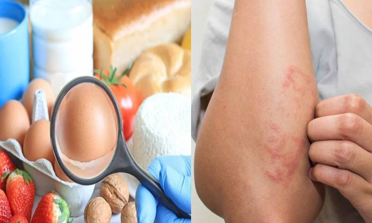 Food Allergy | healthy foods like milk and egg causes food allergy symptoms janiye allergy karne wale food