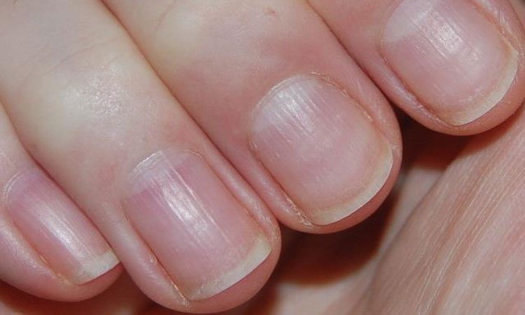 Half Moon on Nails | know what does half moon on nails say about our health