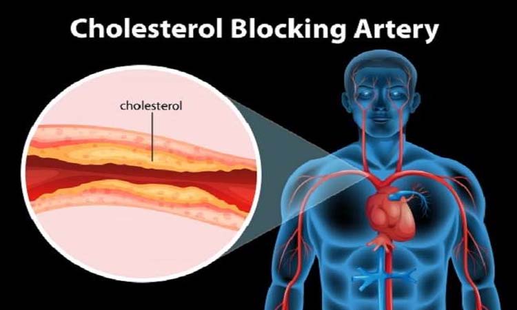 Health Tips | follow these easy tips to remove the problem of blockage in the arteries