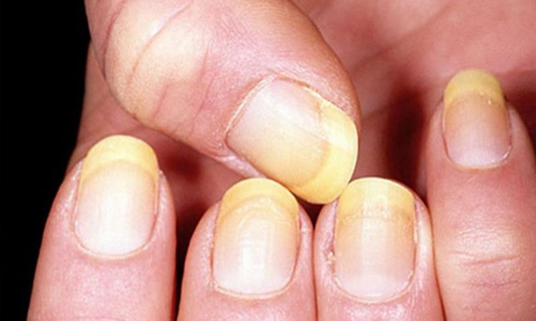Fingernails | fingernails show signs of illness disease health indicaton symptoms