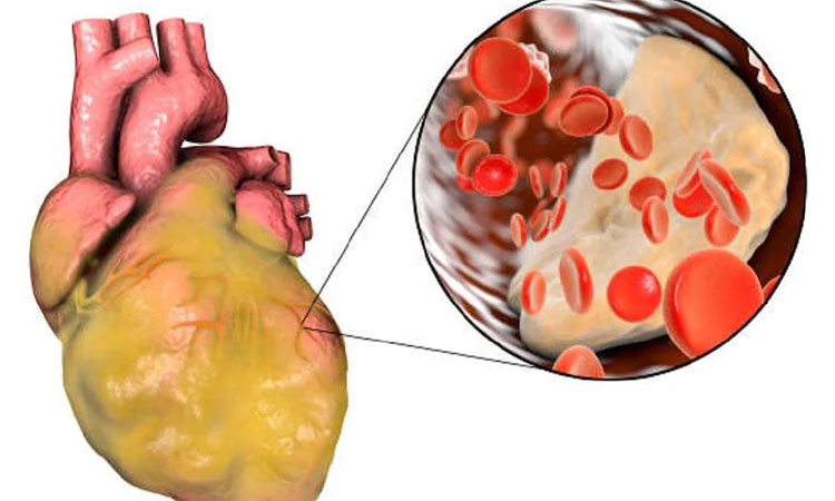 Blood Group And Heart Disease | people of this blood group at high risk of heart diseases