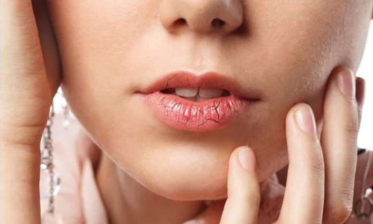 Winter Lip Care | amazing home remedies for dry chapped lips during winters