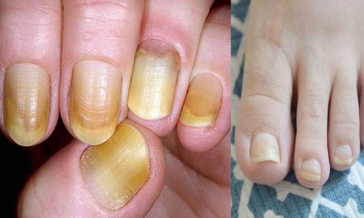 Tips for Beautiful Nails | home remedy to remove yellowness from nails know how to get white and glowing nails