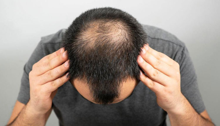 Baldness | whats a baldness in mail and female know the symptoms and cure