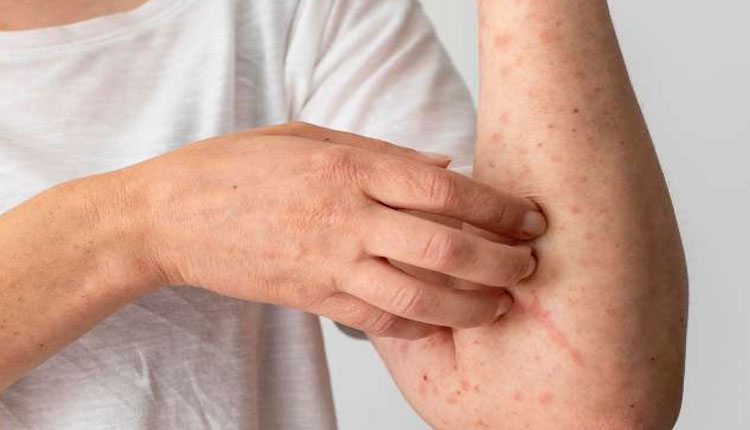 Atopic Dermatitis | what is atopic dermatitis know what experts say about it