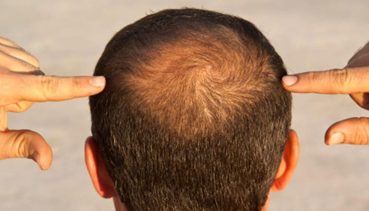 Hair Fall | hair loss common type androgenetic alopecia causes treatment sodium