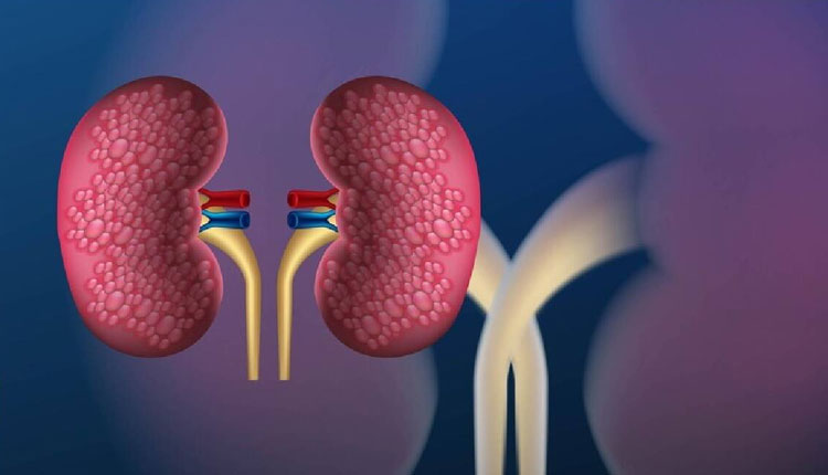 Kidney Problem | know where the pain occurs due to kidney failure know how to take care of kidney