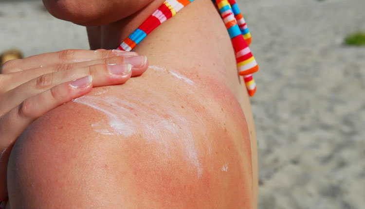 Sun Poisoning | know about sun poisoning symptoms causes and treatment