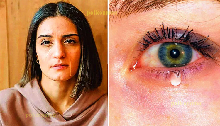 Watery Eyes | watery eyes epiphora or tearing causes treatment dry eyes blocked tear ducts pinkeye allergies