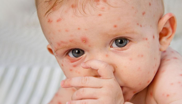Chickenpox | chickenpox causes and symptoms in marathi tips to prevent chickenpox infection