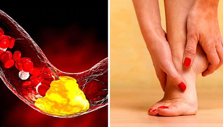 High Cholesterol | high cholesterol warning signs in your body legs feet nails which lead to heart attack stroke