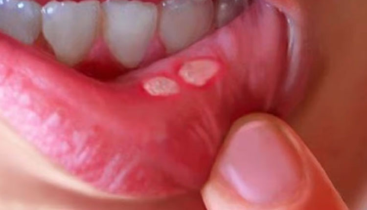 Mouth Ulcers Causes And Treatment