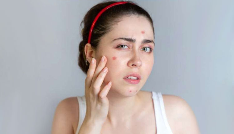 Pimple Home Remedies | 4 homemade face packs for pimples or acne problem