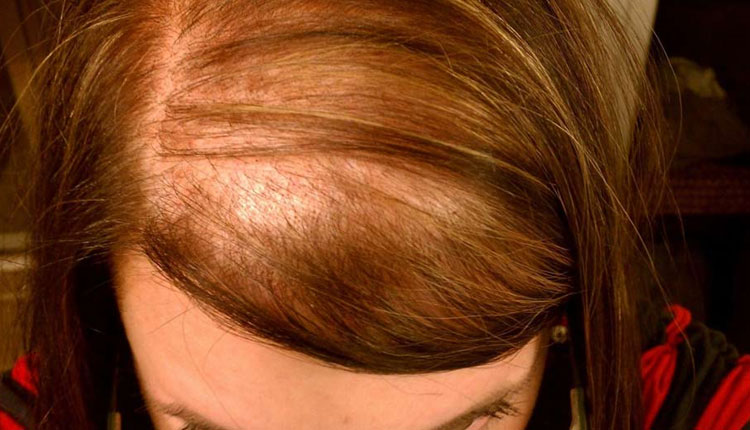 Remedies For Hair Fall | hair fall in women baldness cure remedies castor oil ashwagandha powder growth