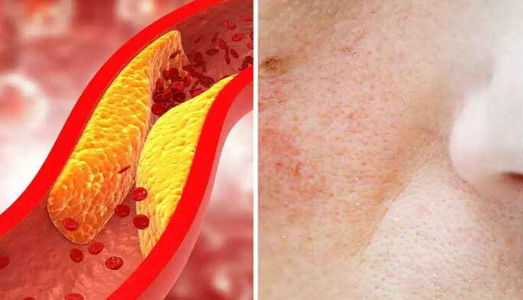 High Cholesterol Sign on skin | expert explained is high cholesterol noticeable how cholesterol symptoms appear on the skin