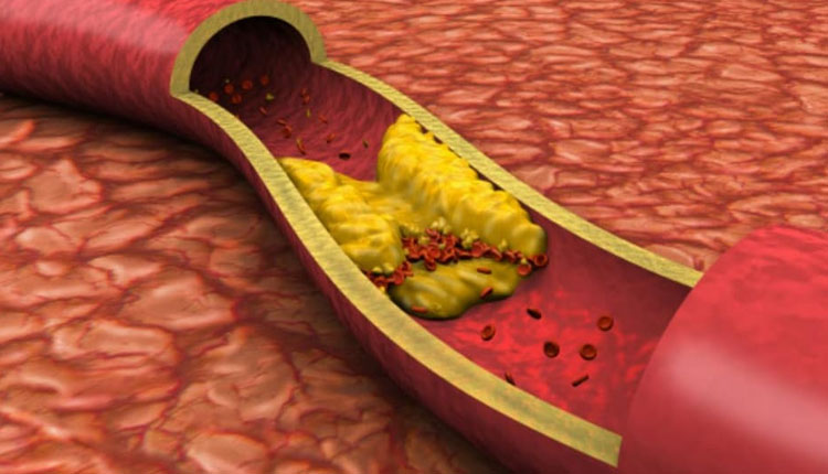 Bad Cholesterol bad cholesterol ways to lower your cholesterol naturally