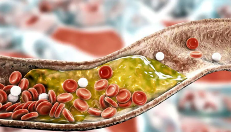 Cholesterol Sudden Increase | high blood cholesterol factors that may cause a sudden increase in cholesterol