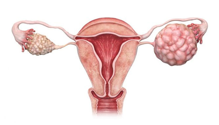 Ovarian Cancer | dont ignore ovarian cancer early signs know the early symptoms