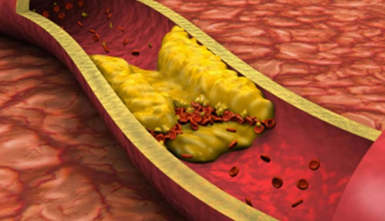 High Cholesterol | high cholesterol dry skin in this area could be a sign of high levels