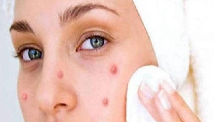 Facing Acne Problem | facing acne problem in women men know its reason and precaution from expert