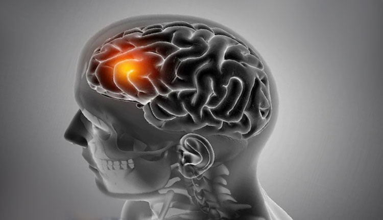 Brain Stroke | headache dizziness do not ignore these very common symptoms may be increased risk of brain stroke