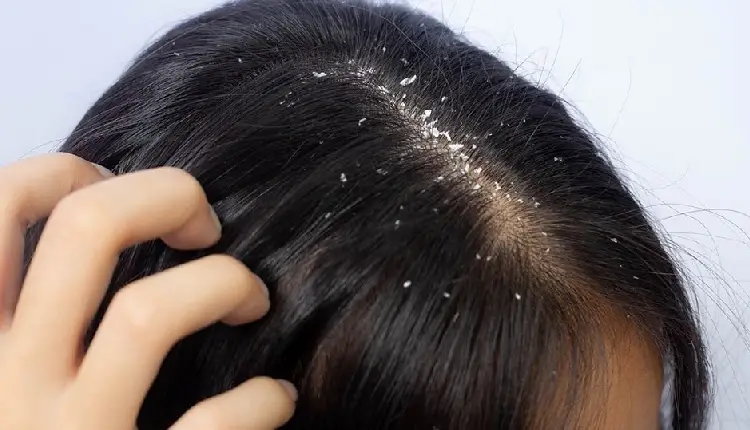 Winter Hair Care | winter hair care know how to take good care of hair in winter 5 home remedies to get rid of dandruff sscmp