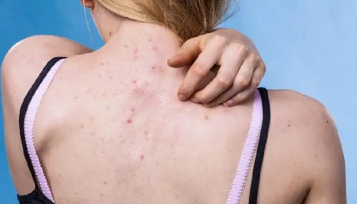 Back Acne | home remedies to remove acne from back