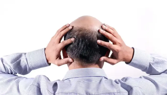 Hair Loss | 5-reasons-of-baldness-ganjapan-hair-care-routine-men-hair-fall-loss-treatment-regrowth-solution
