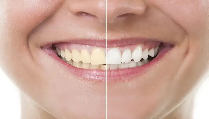 How to Remove Yellowing of Teeth | how to get rid of yellow teeth with 5 home remedies use oil pulling neem baking soda and fruit peels for tooth whitening