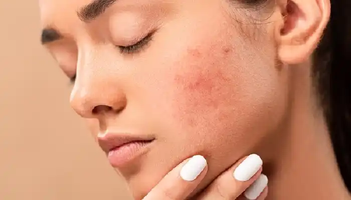Skin Care – Pimples Problem | tips to get rid of acne problem how to get rid of pimples