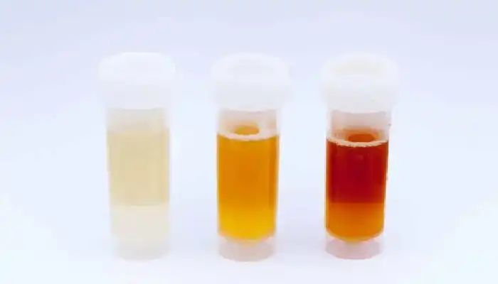 Urine Colour And Its Meaning | urine colours and its meaning light dark yellow green brown cloudy red